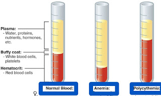 पॉलीसाइथिमिया  Polycythemia (erithrocytosis) anemia