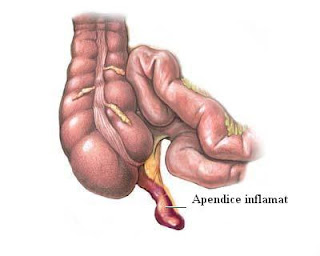 Informatii medicale despre apendicita cronica