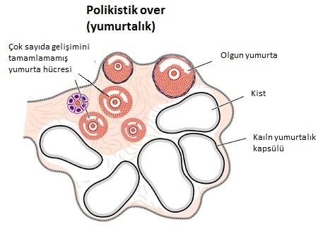 Polikistoz yumurtalıq sindromu (PYS) 