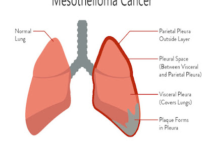 Mesothelioma Cancer