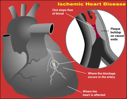 Dr. Ofi Dwi Antoro: IHD (ISCHEMIA HEART DISEASE)