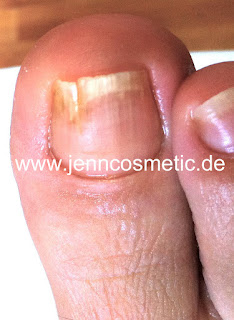 Nagelpilz-ansteckend-jenn-cosmetic