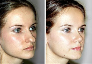 best-nose-plastic-surgery-in-hyderabad