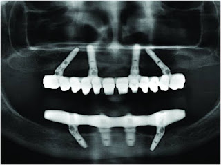 All-on-4™, All-on-6™ Dental Implants