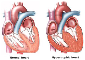 left ventricular hypertrophy