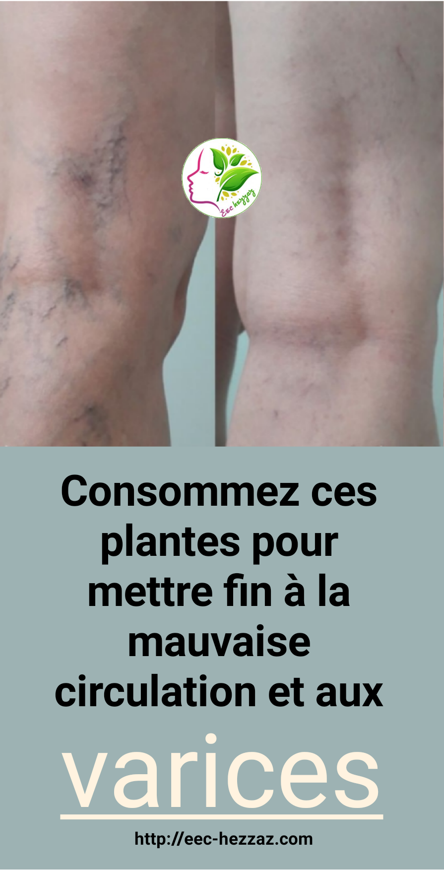 Consommez ces plantes pour mettre fin à la mauvaise circulation et aux varices