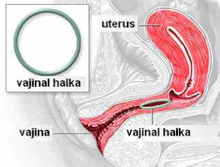 Vajinal halka yerleştirilmesi