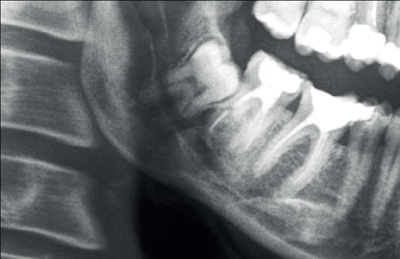 Having advanced periodontitis triples the probability of suffering a future ischemic stroke