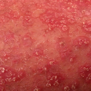 Psoriasis