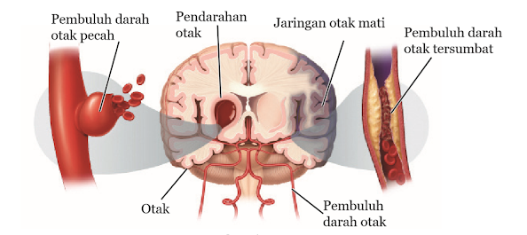 Gambar Penyumbatan Arteri dalam Otak oleh Lemak