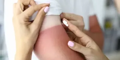 how to treat sunburn,sunburn treatment,how to get rid of sunburn,how to treat a sunburn,sunburn,how to cure sunburn,how to relieve sunburn,how to treat a sunburn naturally,how to,how to treat sunburn fast,treatment,effective sunburn treatments,effective sunburn treatment,how to treat a burn,how to treat sunburn naturally at home,best sunburn treatment,sunburn symptoms,how long does it take for sunburn to heal,how long does it take sunburn to go away