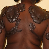 Tattoos And Eczema - Tattoos And Eczema | Healthfully / Eczema is a chronic condition, but symptoms can be dormant.