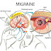 Cara hilangkan Migrain