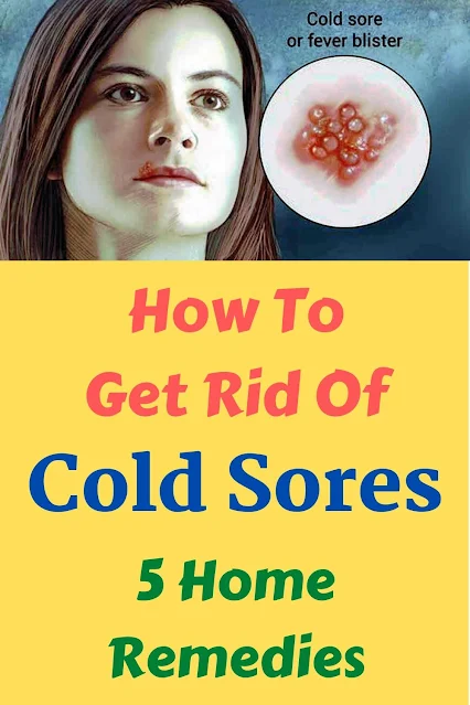 How To Get Rid Of Cold Sores – 5 Home Remedies