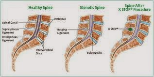 http://www.gohealth.in/treatment/spine-surgery/