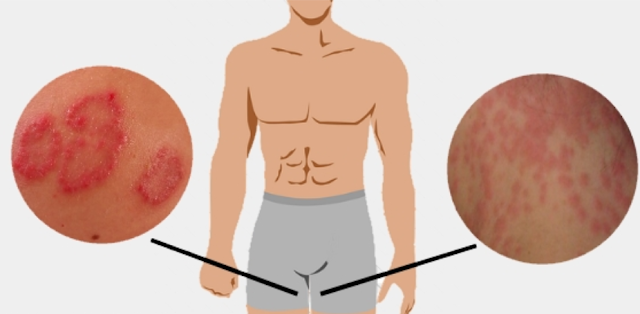 Tinea Cruris | Jock Itch