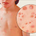 Chicken Pox makes bumps pop up on faces, scalps, and bodies