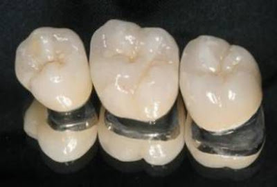 Nha sĩ thường khuyên dùng răng sứ Zirconia