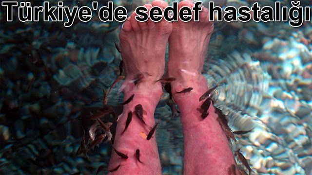 turkiyede sedef hastaligi