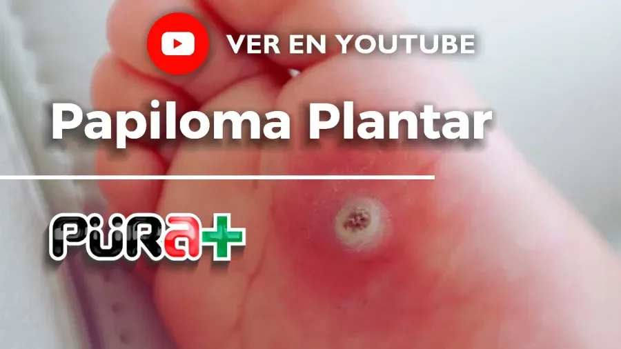 Video sobre El papiloma plantar