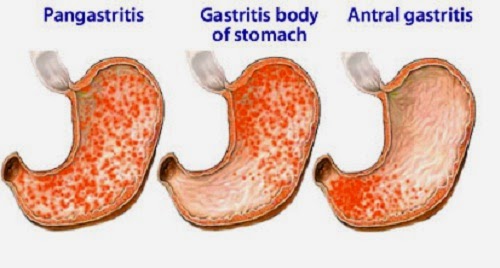 Terapi Non Farmakologi Penyakit Gastritis - TERAPI NON ...