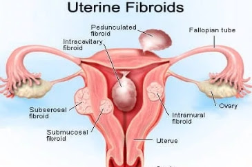 How to Get Rid of Uterine Fibroids without Surger