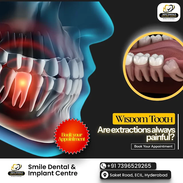 Wisdom Tooth Extractions