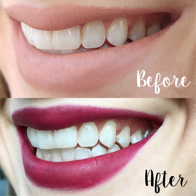 Whitening For Sensitive Teeth + A Giveaway! - Pardon Muah