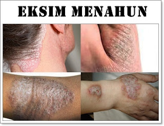 obat ampuh untuk mengtasi eksim menahun di kaki