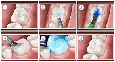 Giải đáp trám răng thưa giá bao nhiêu cho khách hàng-1