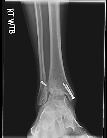 Broken Ankle X-ray-3.bp.blogspot.com