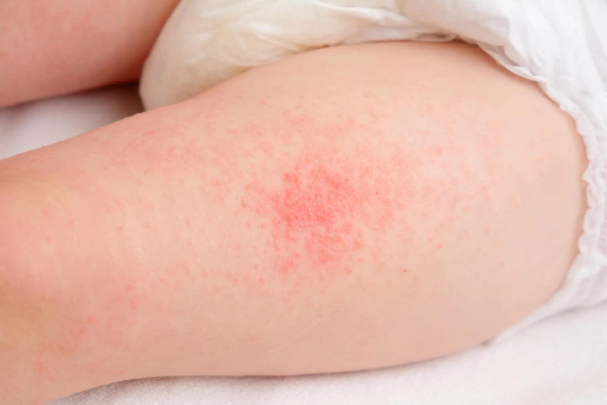 diaper rash prevention tips for nighttime india