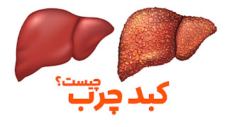 Fatty liver diet