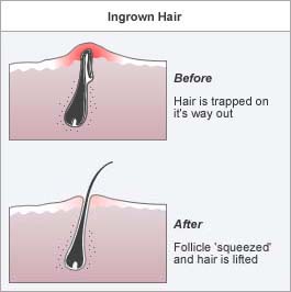 ingrown hair