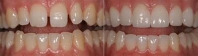 Cách khắc phục răng thưa hiệu quả