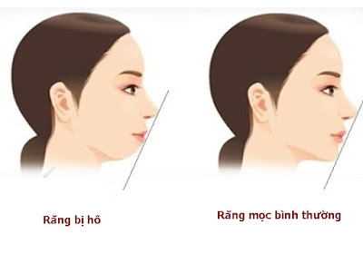 Phương pháp phẫu thuật hàm hô móm là gì?