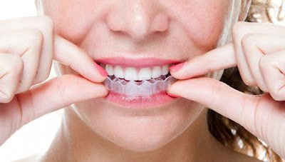 khay-nieng-Invisalign