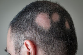 Artikel, Alopecia Areata, Alopecia Areata Adalah, Penyebab Alopecia Areata, Gejala Alopecia Areata, Pengobatan Alopecia Areata