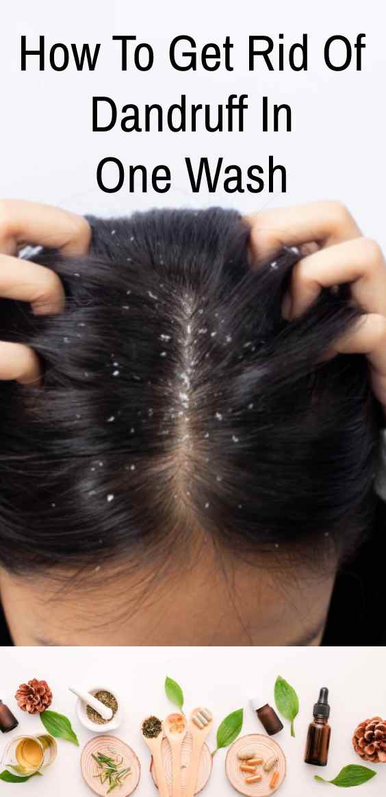 How To Get Rid Of Dandruff In One Wash