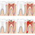 Trường hợp răng hàm nên lấy tủy khi bọc sứ