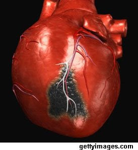 Coronary heart disease 