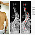 Impaired Physical Mobility Nursing Care Plan Scoliosis