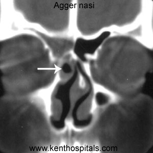 Agger Nasi Cell2