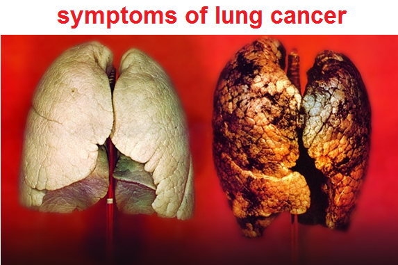 lung cancer is cancer that begins in the lungs the two organs found in 