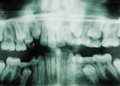 Global Dental Intraoral X-ray Sensor Industry Market Research 2017