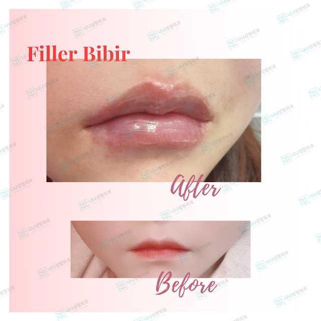 filler bibir, lip filler, filler, suntik filler, botox, botox ujung bibir, bibir sexy, bibir bervolume, bibir indah, dermatologi, dermatologi korea, perawatan dermatologi, dokter korea, dokter dermatologi