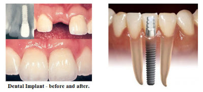 Implant và chi phí trồng răng implant
