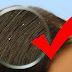 Dandruff (Khushki) Treatment In Urdu