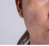 Tips for oily skin | How to take care of oily skin
