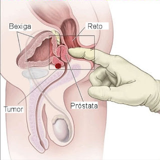 Toque retal para diagnóstico do câncer de próstata